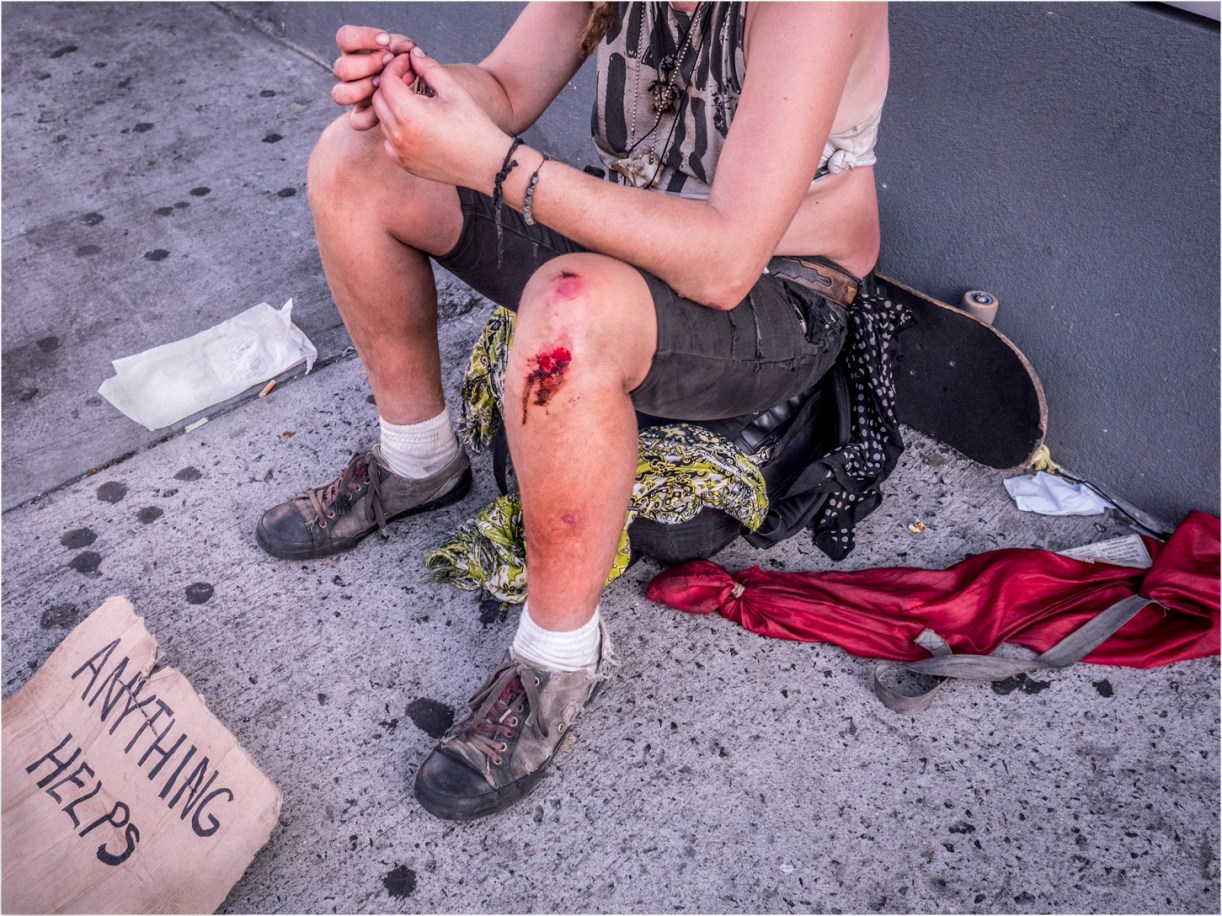 coney-homeless-anything-helpsblood-knee-copy